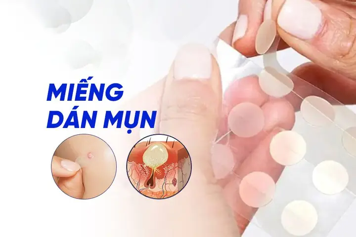 Hút Mụn Có Tác Dụng Gì? Toàn Tập Lợi Ích, Quy Trình, Chi Phí Và Lưu Ý Quan Trọng Năm 2026
